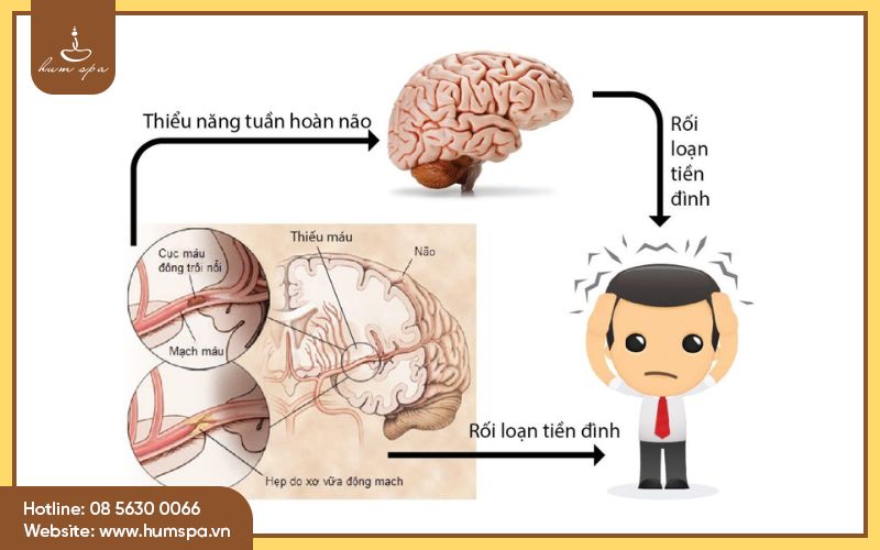  Rối loạn tiền đình là bệnh gì?